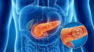 Illustrazione medica del pancreas con massa tumorale evidenziata nell’addome, vista anatomica con ingrandimento